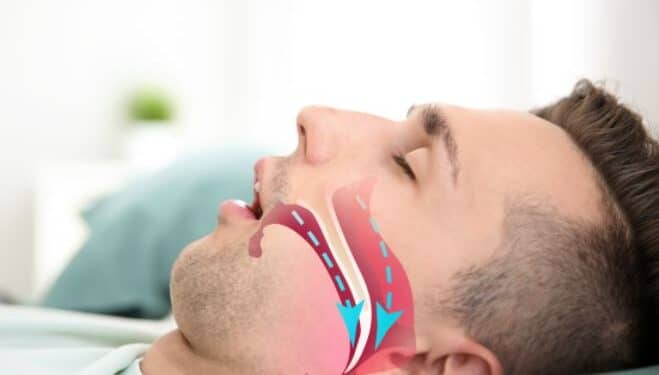 sleep apnea