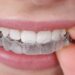 How Much Do Clear Aligners Cost?