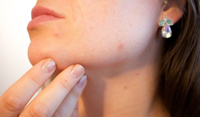 Home Remedies to Treat Pigmentation