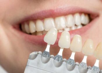 What Are Veneers And How Are They Used in Dentistry