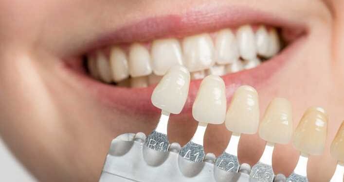 What Are Veneers And How Are They Used in Dentistry