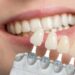 What Are Veneers And How Are They Used in Dentistry