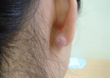 5 Things to Do Before a Keloid Surgery
