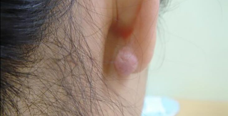 5 Things to Do Before a Keloid Surgery